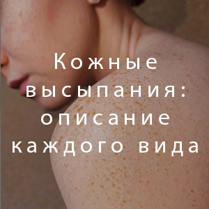 Кожные высыпания: описание каждого вида